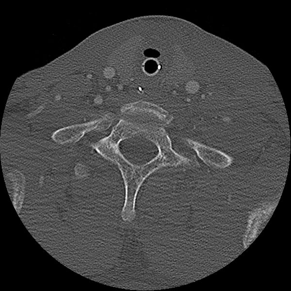 File:Cervical spine fractures with vertebral artery dissection (Radiopaedia 32135-33078 Axial bone window 4).jpg