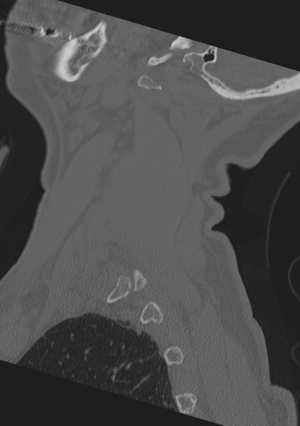 File:Cervical spine fractures with vertebral artery dissection (Radiopaedia 53296-59268 Sagittal bone window 62).png