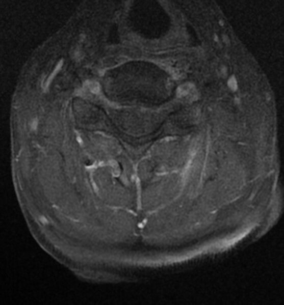 File:Cervical spondylodiscitis (Radiopaedia 81362-95110 Axial T1 C+ fat sat 9).jpg