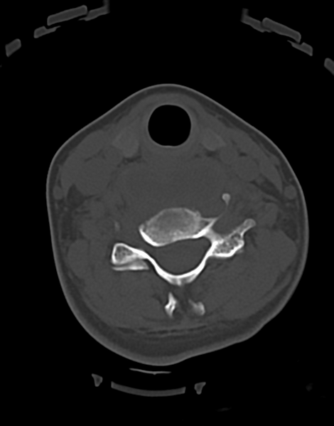 File:Cervical tuberculous spondylitis (Radiopaedia 39149-41365 Axial bone window 34).png