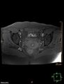 Cesarian scar endometriosis (Radiopaedia 68495-78066 Axial T1 fat sat 16).jpg