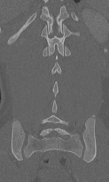 File:Chance fracture (Radiopaedia 40360-42912 Coronal bone window 52).png