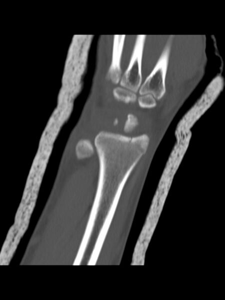 File:Chauffeur's (Hutchinson) fracture (Radiopaedia 58043-65079 Coronal bone window 10).jpg
