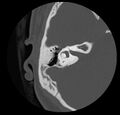 Cholesteatoma (Radiopaedia 20296-20217 bone window 29).jpg