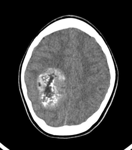 File:Choroid plexus carcinoma (Radiopaedia 91013-108552 Axial non-contrast 44).jpg