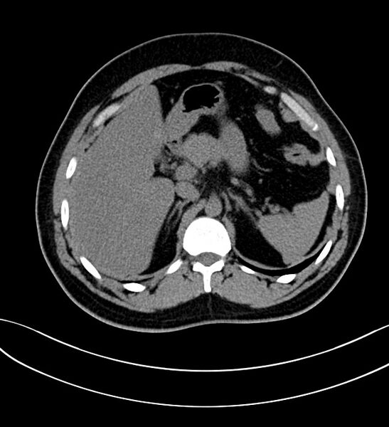 File:Chromophobe renal cell carcinoma (Radiopaedia 84286-99573 Axial non-contrast 10).jpg