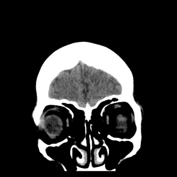 File:Chronic bilateral occipital lobe infarcts (Radiopaedia 31276-31996 Coronal non-contrast 9).jpg