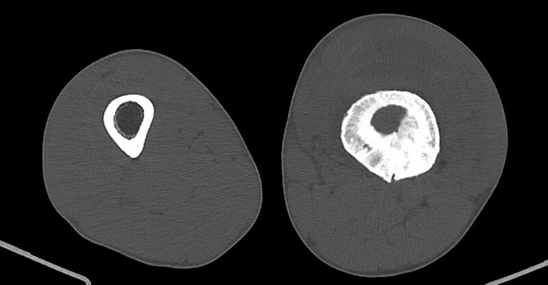 File:Chronic osteomyelitis (with sequestrum) (Radiopaedia 74813-85822 Axial non-contrast 119).jpg