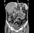Chronic pancreatitis (Radiopaedia 23132-23172 C 29).jpg