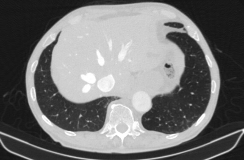 File:Chronic pulmonary embolism (Radiopaedia 91241-108843 Axial lung window 81).jpg