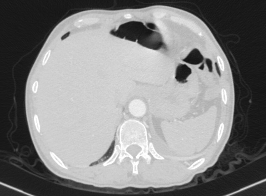Chronic pulmonary embolism with bubbly consolidation (Radiopaedia 91248-108850 Axial lung window 140).jpg