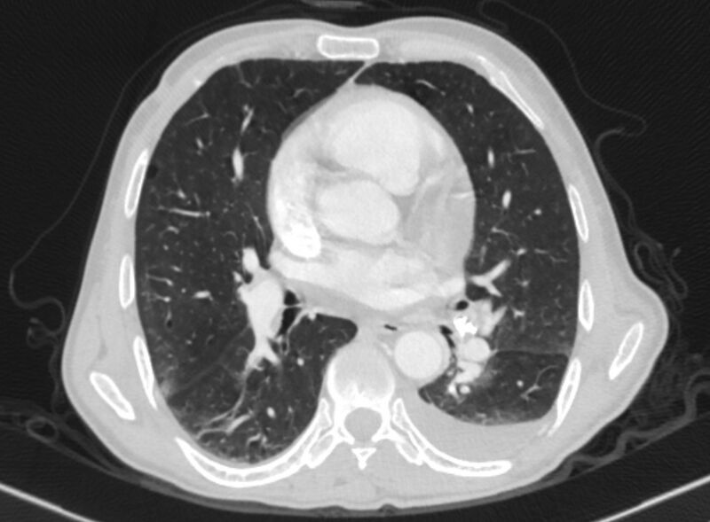 File:Chronic pulmonary embolism with bubbly consolidation (Radiopaedia 91248-108850 Axial lung window 87).jpg