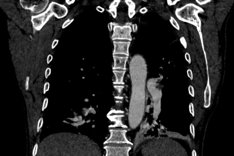 File:Chronic pulmonary embolism with bubbly consolidation (Radiopaedia 91248-108850 B 100).jpg