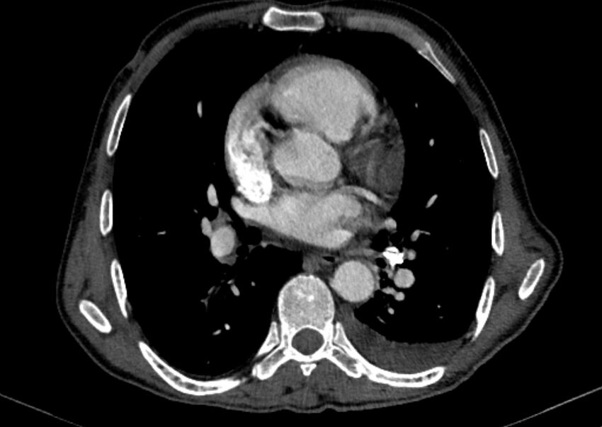 Chronic pulmonary embolism with bubbly consolidation (Radiopaedia 91248-108850 C+ arterial phase 84).jpg