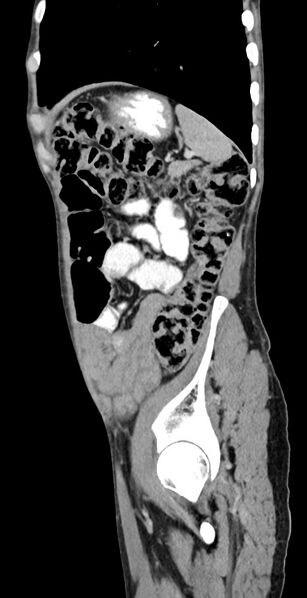 File:Chronic small bowel volvulus (Radiopaedia 75224-86322 C 36).jpg