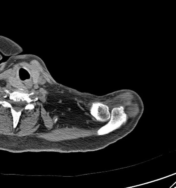 File:Clear cell chondrosarcoma - humerus (Radiopaedia 63104-71612 Axial non-contrast 8).jpg