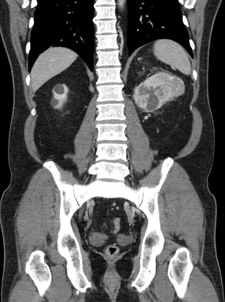 File:Clear cell renal cell carcinoma (Radiopaedia 61449-69393 F 37).jpg