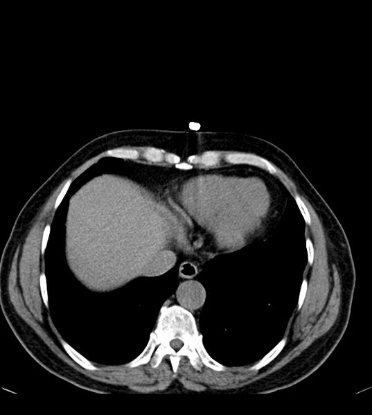 File:Clear cell renal cell carcinoma (Radiopaedia 85006-100539 Axial non-contrast 13).jpg