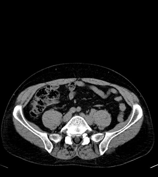 File:Clear cell renal cell carcinoma (Radiopaedia 85006-100539 Axial non-contrast 62).jpg