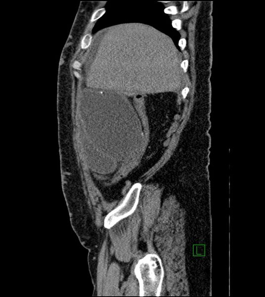 File:Closed-loop small bowel obstruction-internal hernia (Radiopaedia 78439-91096 C 118).jpg