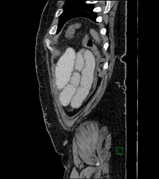 File:Closed-loop small bowel obstruction-internal hernia (Radiopaedia 78439-91096 C 26).jpg