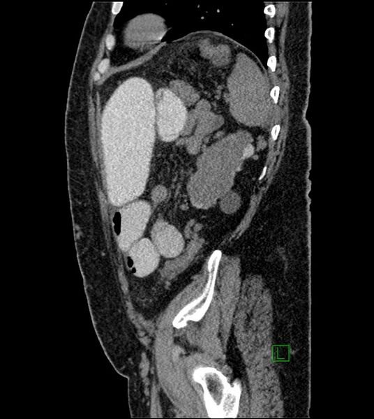 File:Closed-loop small bowel obstruction-internal hernia (Radiopaedia 78439-91096 C 40).jpg