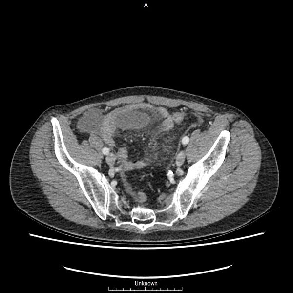 File:Closed loop bowel obstruction and ischemia (Radiopaedia 86959-103180 A 71).jpg