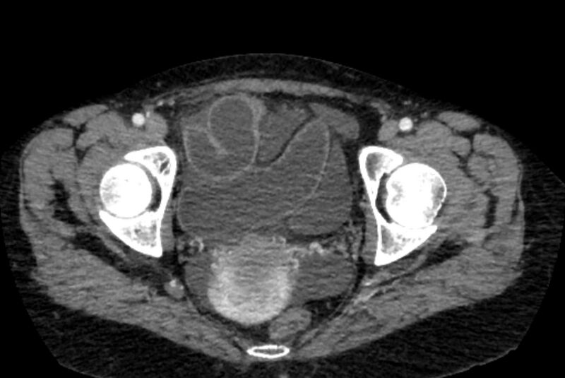 File:Closed loop small bowel obstruction (Radiopaedia 71211-81508 A 157).jpg