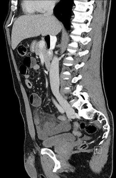 File:Closed loop small bowel obstruction - internal hernia (Radiopaedia 57806-64778 C 63).jpg