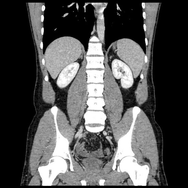 File:Co-existing acute appendicitis and epiploic appendagitis (Radiopaedia 61789-69911 C 44).jpg
