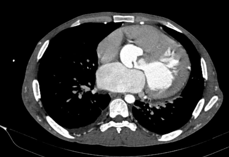 File:Coarctation of aorta with aortic valve stenosis (Radiopaedia 70463-80574 A 125).jpg