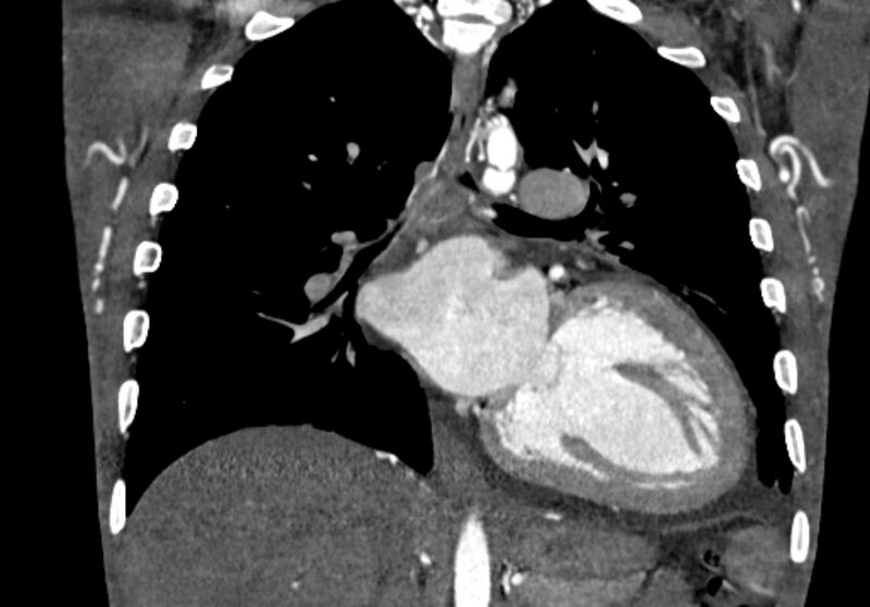 File:Coarctation of aorta with aortic valve stenosis (Radiopaedia 70463-80574 C 140).jpg