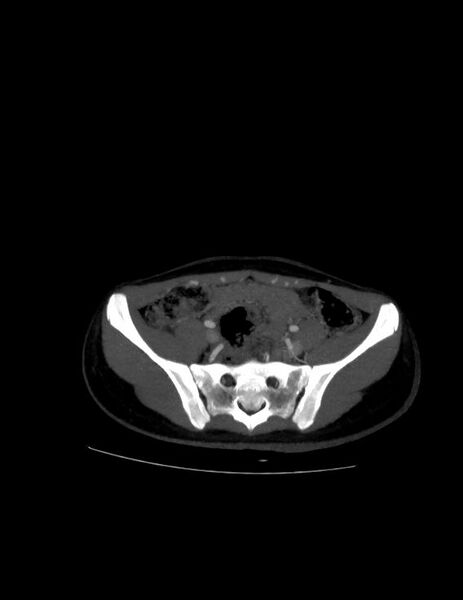 File:Coarctation of the aorta (Radiopaedia 27458-27657 D 42).jpg