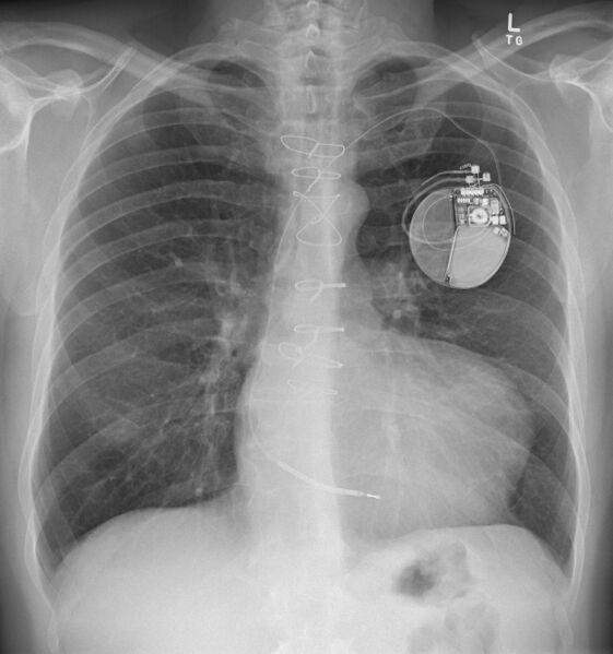 File:Left ventricular aneurysm (Radiopaedia 73089).jpg