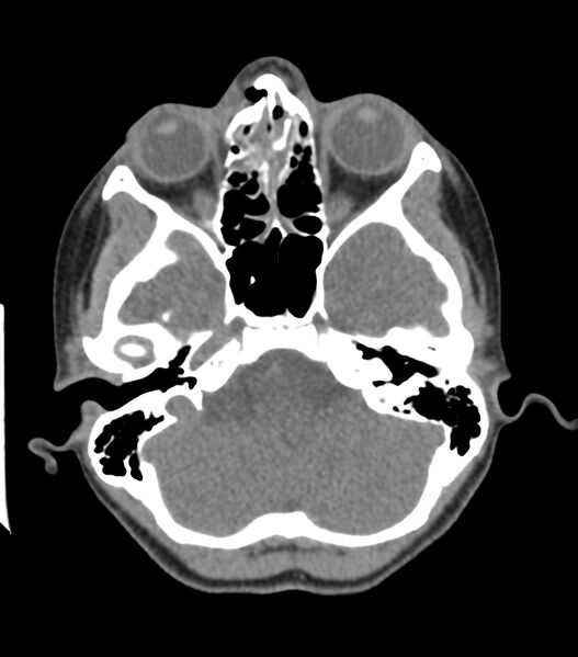 File:Nasoorbitoethmoid fracture (Radiopaedia 90044-107205 Axial non-contrast 153).jpg