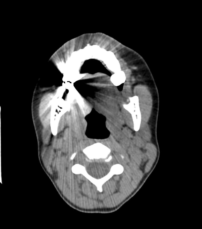 Nasoorbitoethmoid fracture (Radiopaedia 90044-107205 Axial non-contrast 83).jpg