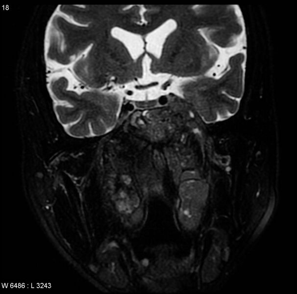 File:Nasopharyngeal carcinoma (Radiopaedia 4546-6667 Coronal T2 6).jpg