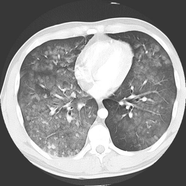 File:Near drowning pulmonary edema (Radiopaedia 16868-16591 Axial lung window 32).jpg