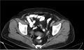 Necrotizing pancreatitis (Radiopaedia 20595-20495 A 40).jpg