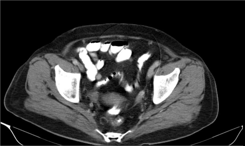 File:Necrotizing pancreatitis (Radiopaedia 20595-20495 A 40).jpg
