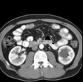 Necrotizing pancreatitis with acute necrotic collection (Radiopaedia 14470-14417 B 23).jpg
