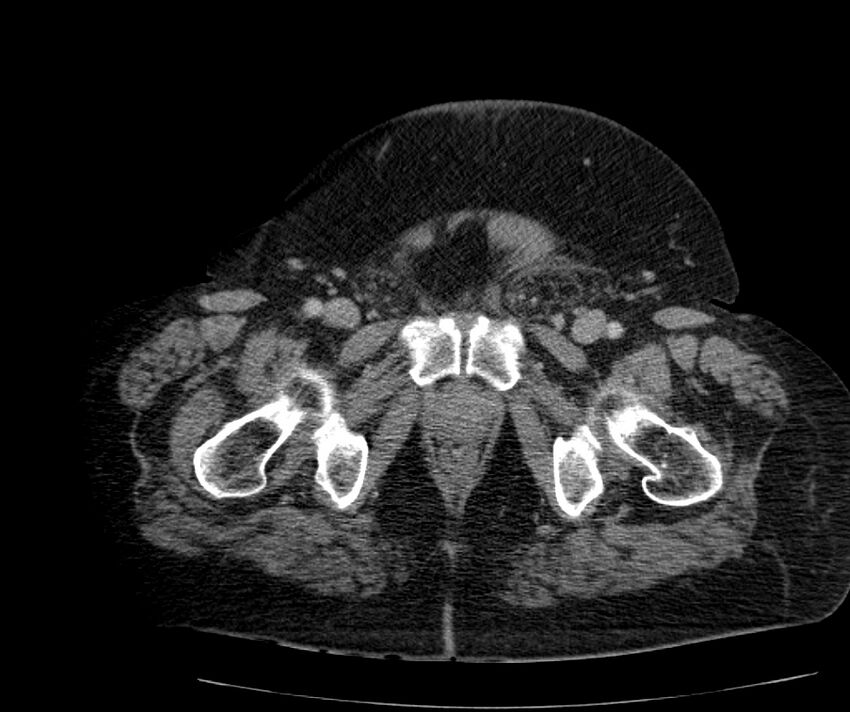 Nephroptosis with inguinal hernia containing perirenal fat (Radiopaedia 56632-63391 C 330).jpg