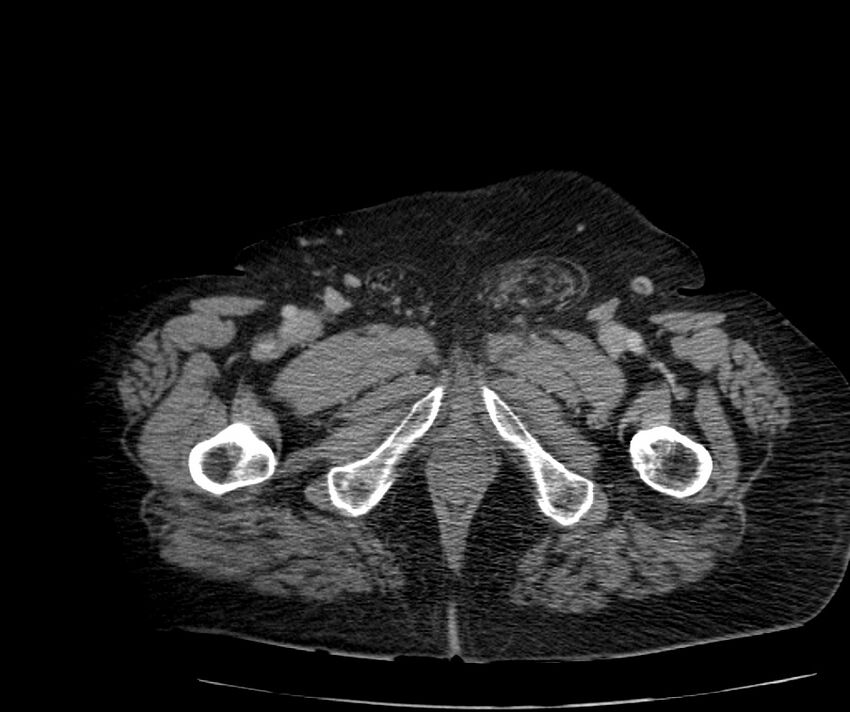 Nephroptosis with inguinal hernia containing perirenal fat (Radiopaedia 56632-63391 C 347).jpg