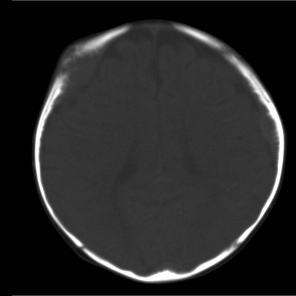 File:Neuroblastoma with skull metastases (Radiopaedia 30326-30958 Axial bone window 14).jpg