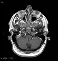 Neurosarcoidosis (Radiopaedia 10930-11351 Axial T1 C+ 3).jpg