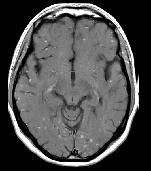 File:Neurosarcoidosis (Radiopaedia 11674-12037 Axial 5).jpg