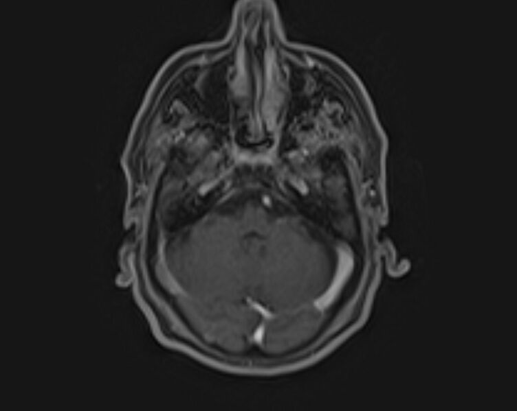File:Non-Hodgkin lymphoma - parotid gland (Radiopaedia 71531-81890 E 21).jpg