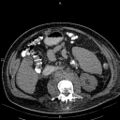 Non Hodgkin lymphoma in a patient with ankylosing spondylitis (Radiopaedia 84323-99621 Axial non-contrast 39).jpg