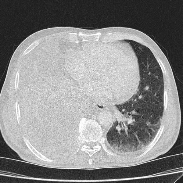 File:Non small-cell lung cancer (Radiopaedia 24467-24769 lung window 34).jpg