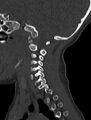 Normal CT cervical spine - pediatric (Radiopaedia 52549-58462 Sagittal bone window 152).jpg